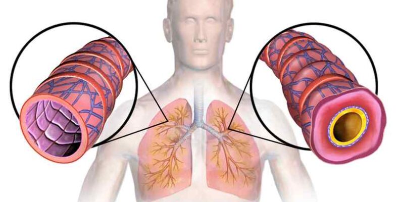 Az első donoros légcsőátültetést végezték el az Egyesült Államokban
